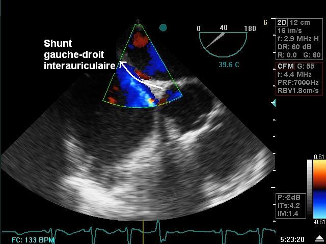 Hypoxmie Shunt%20gd%20eto