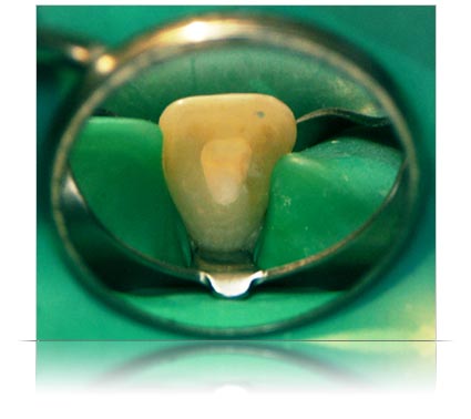 Comment se déroule le traitement endodontique ? Obturation-canalaire