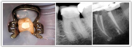 Les suites du traitement endodontique Restauration-prothetique