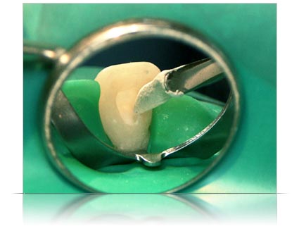 Comment se déroule le traitement endodontique ? Scellement-espaces-canalaires