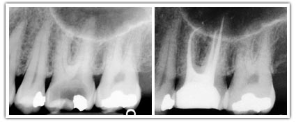 Quelle est la durée du traitement endodontique ? Traitement-endodontique-2