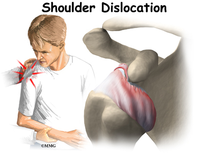 دورة تدريبة  عن الإسعافات الأولية  ( ريثما يحضر الطبيب ) Shoulder_dislocation_intro01