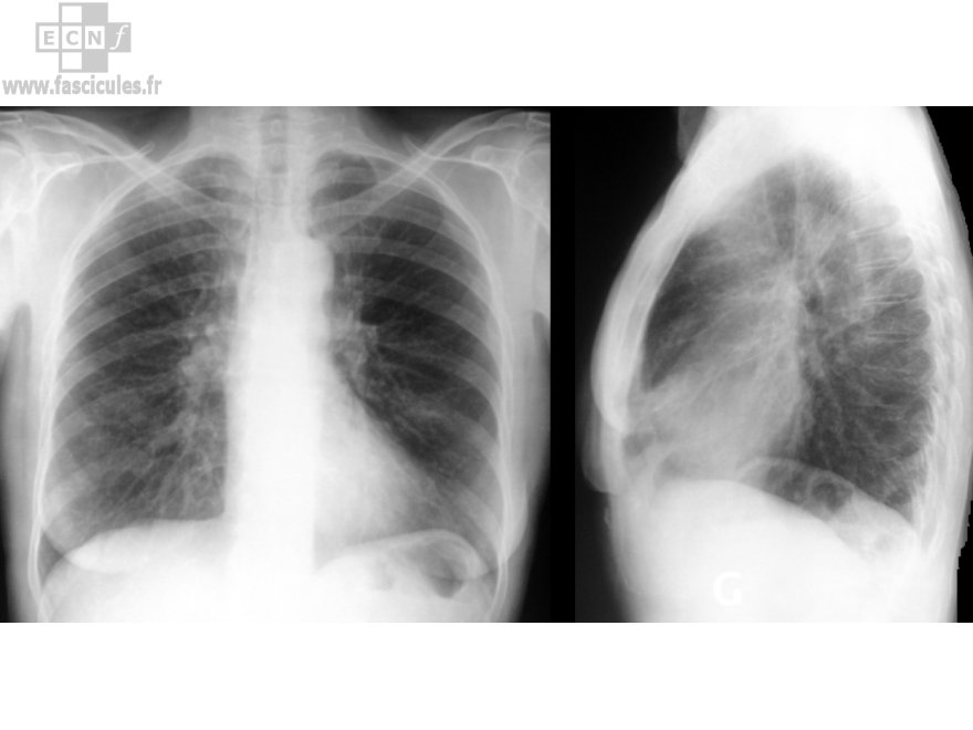 Cours et TD biochimie clinique (2010/2011) Pneumologie-radiographie-poumons-pulmonaire-thorax-normale-rJtxkA0HPj