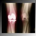 الموسوعه الطبيه الشامله ( 4 ) Osteoporosis