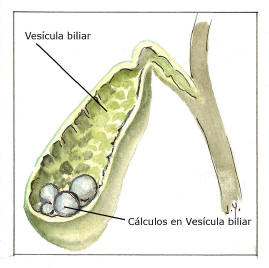 Mestalla, un artefacto, la vesícula del Pilar 200_vesiculaCalculos_rotulo268