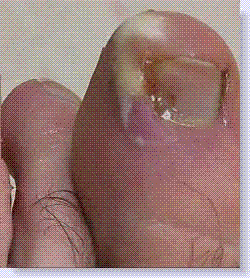 12- Hand infections and trauma Paronychia