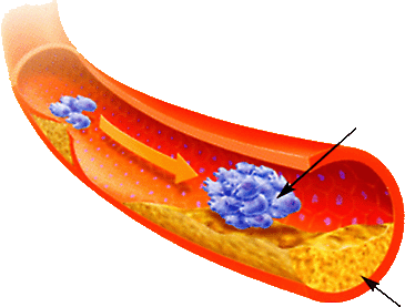 Maladies cardiaques  Thrombose