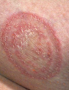 tinea corporisفطريات جلدية Fungal_2