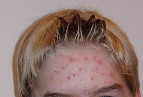  حب الشباب والبثور اسباب . اعراض . علاج  Acne_cure_vitamin