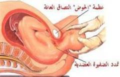 شلل ارب والعلاج الطبيعي  Erb%20(1)