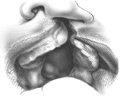 الشفة الارنبية بين التشوه ومشاكل النطق  Cleft-B%20%2811%29