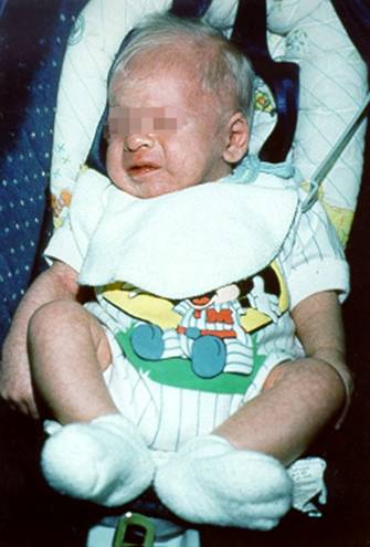 المتلازمات Syndromes -موضوع شامل  Albinism%20%281%29