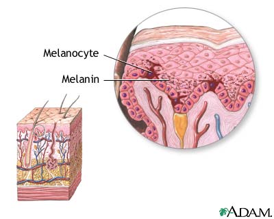 المتلازمات Syndromes -موضوع شامل  Albinism%20%282%29