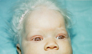 المتلازمات Syndromes -موضوع شامل  Albinism%20%284%29