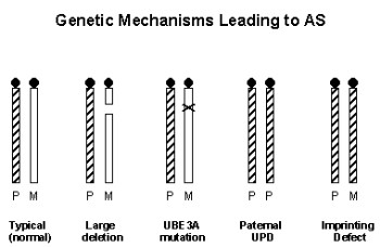 متلازمة انجلمان  Angelmans Syndrome Angelmans%20%282%29