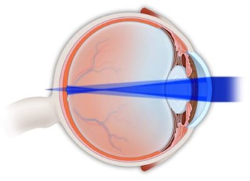 حرج النظر - الاستجماتيزم  Astigmatism AstigmatismA5