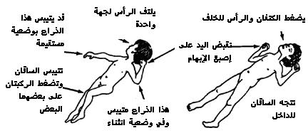 الشلل الدماغي CP-B