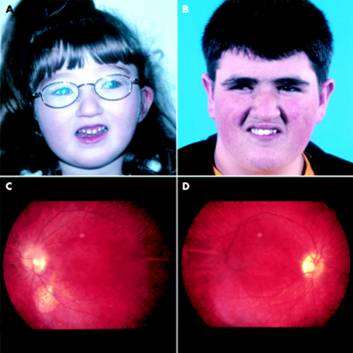 المتلازمات Syndromes -موضوع شامل  Cohen_syndrome%20%282%29