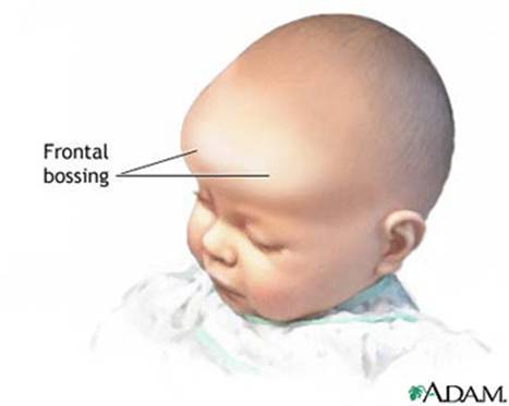 المتلازمات Syndromes -موضوع شامل  Crouzon_2