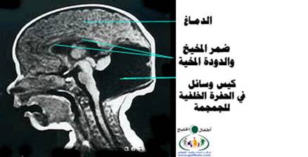 المتلازمات Syndromes -موضوع شامل  Dandy%20%282%29