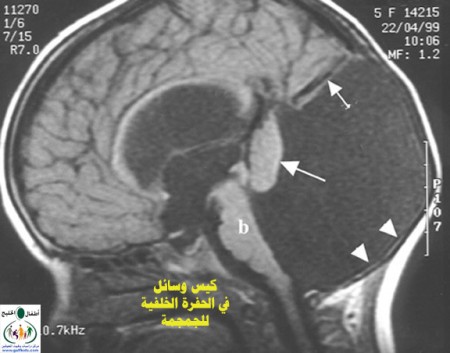 المتلازمات Syndromes -موضوع شامل  Dandy%20%284%29