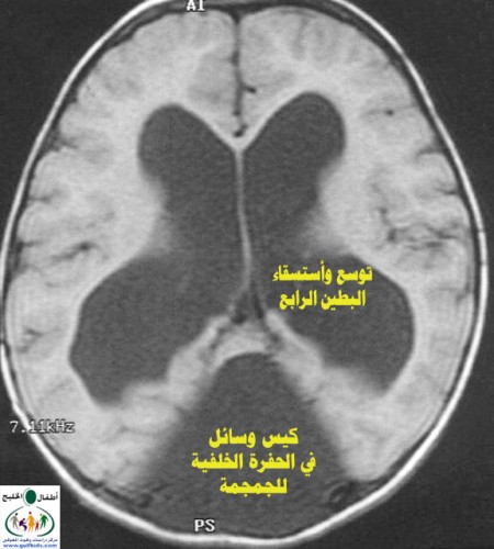 المتلازمات Syndromes -موضوع شامل  Dandy