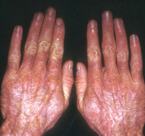  التهاب الجلد والعضلات Dermatomyositis%20%2814%29