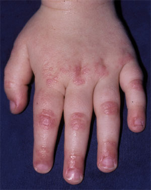  التهاب الجلد والعضلات Dermatomyositis%20%282%29