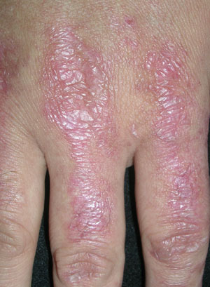  التهاب الجلد والعضلات Dermatomyositis%20%284%29