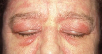  التهاب الجلد والعضلات Dermatomyositis%20%287%29