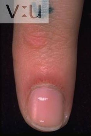  التهاب الجلد والعضلات Dermatomyositis%20%288%29