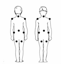  التهاب الجلد والعضلات Dermatomyositis%20%289%29