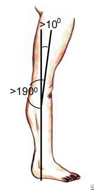 المتلازمات Syndromes -موضوع شامل  EDS%20%285%29