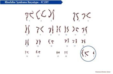 هام جدا جدا  المتلازمات بجميع انواعها  Klinefelter%20(3)