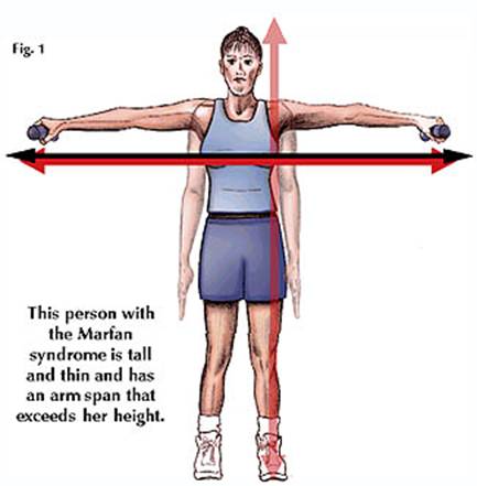 متلازمة مارافان Marfan