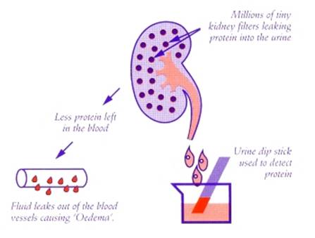 المتلازمات Syndromes -موضوع شامل  Nephrotic_Syndrome%20%281%29