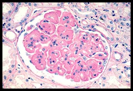 المتلازمات Syndromes -موضوع شامل  Nephrotic_Syndrome%20%282%29