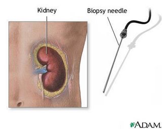 المتلازمات Syndromes -موضوع شامل  Nephrotic_Syndrome%20%289%29