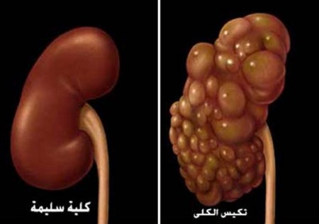 مرض التكيس الكلوي Polycystic kidney disease - PKD Polycystic