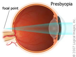 مد البصر الشيخوخي أو القدع Presbyopia PresbyopiaA2