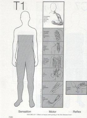 التأهيل الحركي لإصابات النخاع الشوكي Taheel%20%284%29