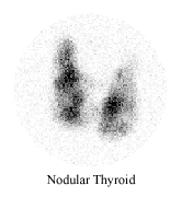 تضخم الغُدَّةِ الدَّرَقِيَةِ أو إنتفاخ الغدة الدرقية أو الجويتر Thyroid_c%20%286%29