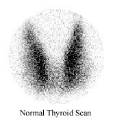 تضخم الغُدَّةِ الدَّرَقِيَةِ أو إنتفاخ الغدة الدرقية أو الجويتر Thyroid_c