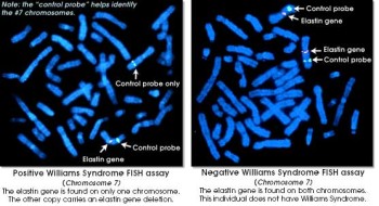 المتلازمات Syndromes -موضوع شامل  William%20%285%29