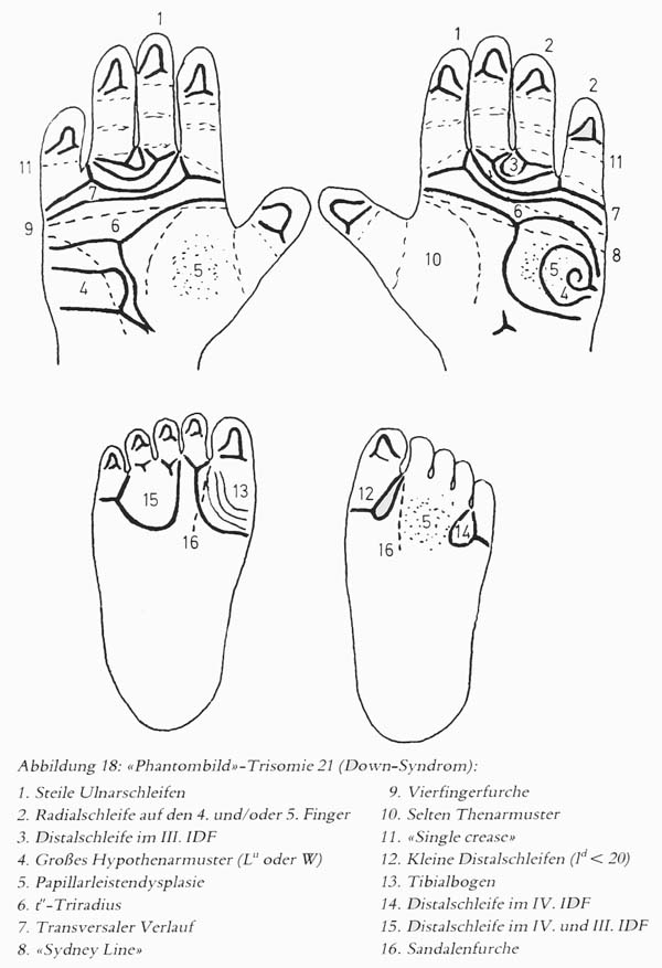 DOWN SYNDROME - The language of the hands! Hand-chart-down-syndrome-hautleistenfibel-rodewald-zankl-1981