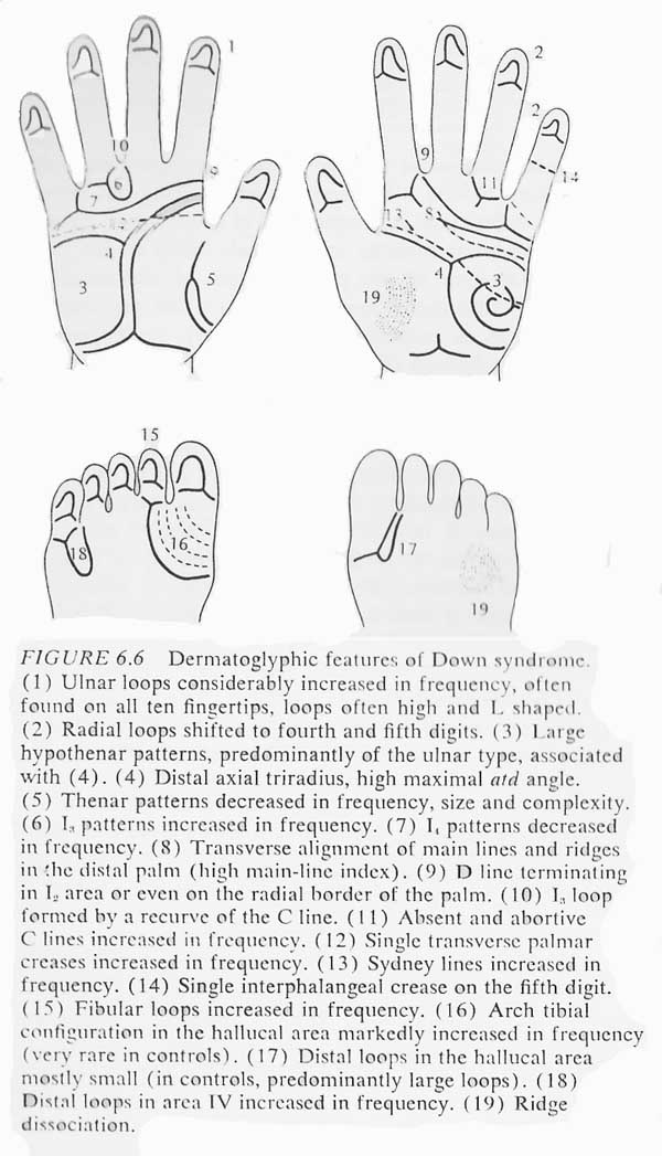 DOWN SYNDROME - The language of the hands! Hand-chart-down-syndrome-schaumann-alter-1976