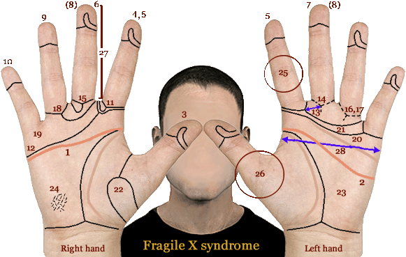 TOP 5 Hand signs in Fragile-X syndrome, co-occurs with autism in about 5% of cases! Simian-line-phantom-picture-fragile-x-syndrome