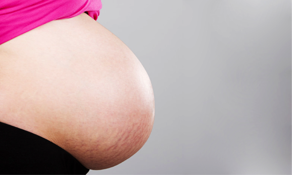 Mẹo vặt làm đẹp: Triệu chứng phân biệt rạn da khi mang thai là gì 00%20(1)