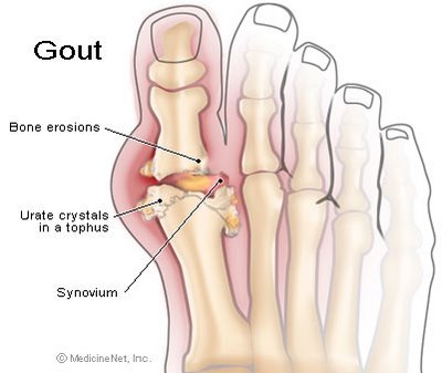 Bệnh gout đến từ đâu? Gout