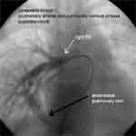 Scimitar Syndrome Cardiac_case4_3_thumb